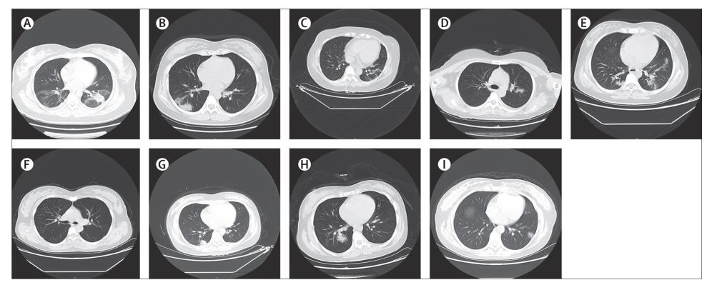 FigureChest CT scans (transverse plane) of nine patients