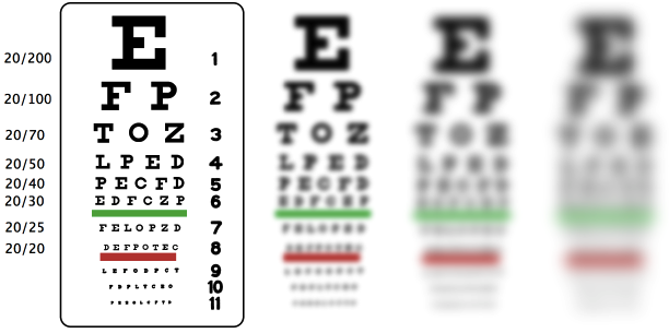 Myopia Degree Chart