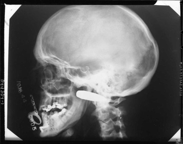 A 0.50 caliber bullet wound of the face. The patient was injured while heating a 0.50 caliber incendiary machine gun bullet with a blowtorch in a World War II-era accident. Image credit: the National Museum of Health and Medicine.