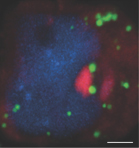 "Laundry soap" in human cells: The Inclusion bodies are in red, lipid droplets in green. 